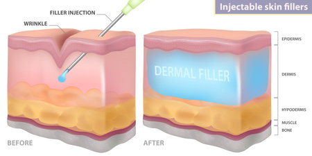Injection filler injection under the skin, dermal layer, vector illustrationのイラスト素材