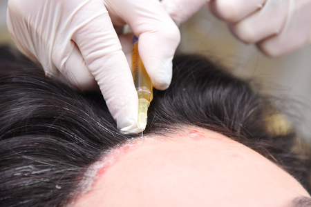 Psoriasis. Hairy part of the head. Plasma injection. Treatment of zabolivanie plasma human blood.の写真素材