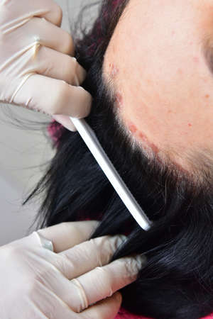 Psoriasis. Hairy part of the head. Plasma injection. Treatment of zabolivanie plasma human blood. Plasmoliftingの写真素材