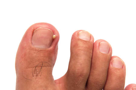 ingrown nail or Onychocrytosis with abscess on white backgroundの写真素材