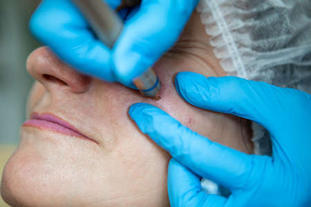 Removal of red spots, rosacea, blood vessels, on the face of a Caucasian woman. Laser apparatus.の写真素材