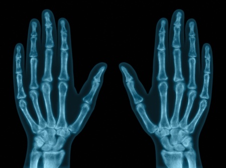 X-ray of both hands. Concept of exam.