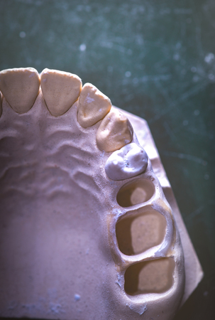 Dental prosthesis, artificial tooth. Photo of artificial teeth made in the dental laboratory.