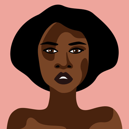 Portrait of African American girl with vitiligo vector skin diseaseのイラスト素材