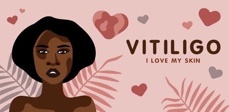 Banner about vitilingo skin disease with young beautiful African American woman minimalistic vectorのイラスト素材