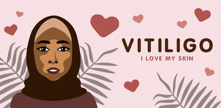 Banner about vitilingo skin disease with young beautiful Muslim woman minimalistic vectorのイラスト素材