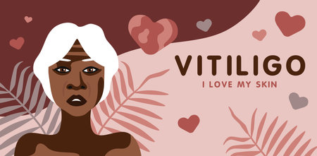 Banner about vitilingo skin disease with elderly African American woman minimalistic vectorのイラスト素材