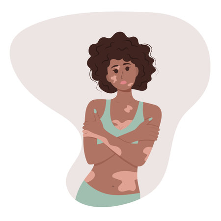 Beautiful African American woman with vitiligo.のイラスト素材