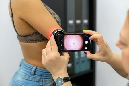 A professional doctor dermatologist advises young patient. Examines a mole on the arm with a...