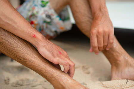 The guy got abrasions after an unsuccessful fall from the surf board. A wet guy on the shore examines an injured armの写真素材