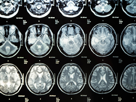 Film x ray brain tumor my mather ,Bangkok,Thailandの写真素材