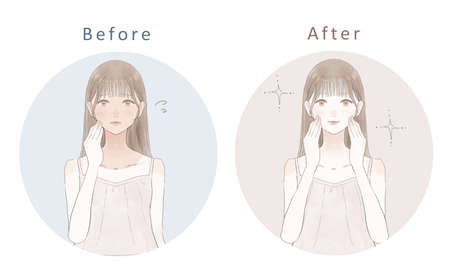 Before and after of a woman suffering from sunburn. On white background.のイラスト素材