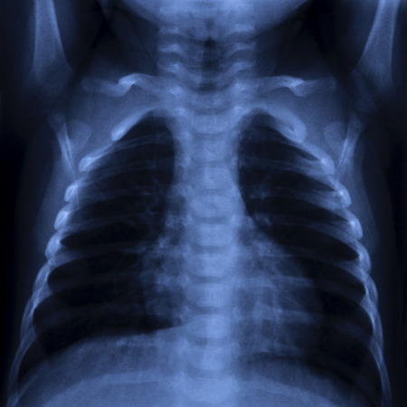 X Ray of a thorax with visible lung, ribs, spine and heart 