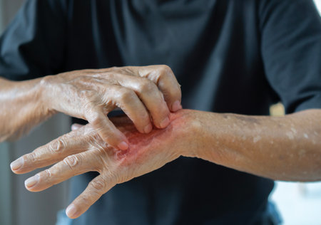 Asian elder man scratching his hand. Concept of itchy skin diseases such as scabies, fungal infection, eczema, psoriasis, rash, allergy, etc. Selctive focus on hands.の写真素材