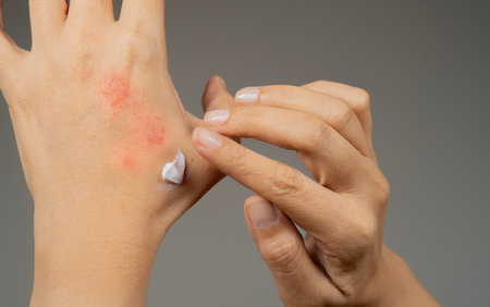 Cropped shot view of woman applying moisturizer cream on her hand for dry flaky skin, as in the treatment of psoriasis, eczema and other diseases of dry skinの写真素材