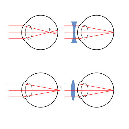 Illustration of how the structure of the eye optical system, visual defects and workaroundsのイラスト素材