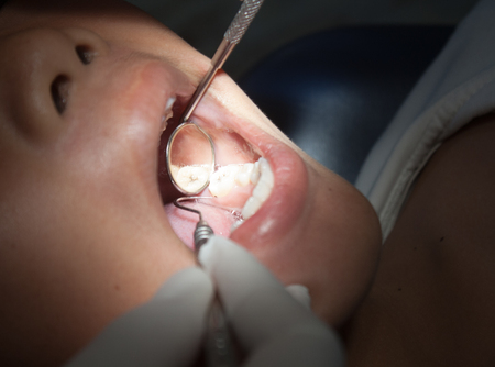 Dentists use mouth Working in the mirror, and the reflection of light in the mouth.