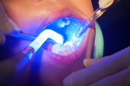 Dark, dental sealants for children aged 7 years.の写真素材