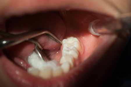 Child dentistry, fillings, sterile gauze.の写真素材