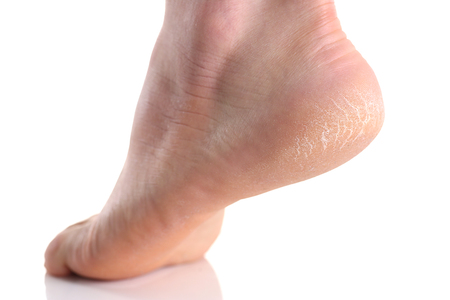 The heel of the foot with bad skin is covered with cracksの写真素材