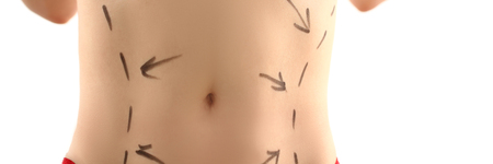 Female body stomach with markup before liposuction shaping surgery for surgeon concept closeupの写真素材