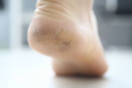 On the dirty heel cracked hard skinの写真素材