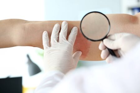 Focus on special dermatological magnifying glass used to inspect red rush spreading on bad skin of suffering patient. Dermatology clinic advertisement concept. Blurred backgroundの写真素材