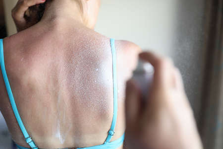 Protective aerosol is applied to sunburn on womans back. Skin disease treatment concept.の写真素材