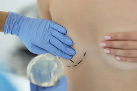 Hand in rubber medical glove holds womans mammary gland with drawn line around closeup. Plastic...