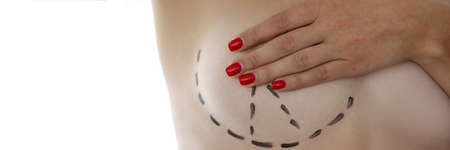 Woman covers her breast with her hand with preoperative marking with surgical marker in clinic. Plastic surgery and aesthetic medicine concept.の写真素材