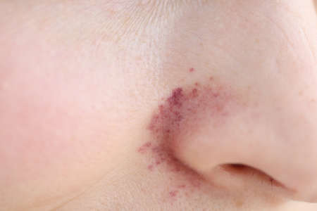 Rash on skin near woman nose closeup