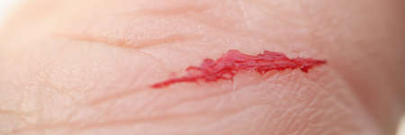 Closeup of scratch with blood on man hand