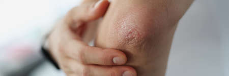 Male elbow and flaky skin and psoriasisの写真素材