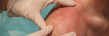 Doctor dermatologist examining rash on skin of man shoulders using gloves closeup