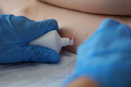 Doctor examine red rash on kid legs in hospital and apply cream from tubeの写真素材