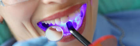Young woman treating teeth with cordless LED curing light machine closeupの写真素材