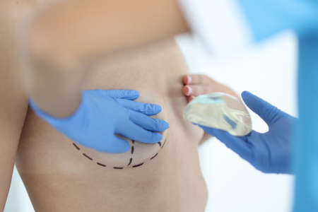 Plastic surgeon holds silicone chest implant for breast augmentationの写真素材