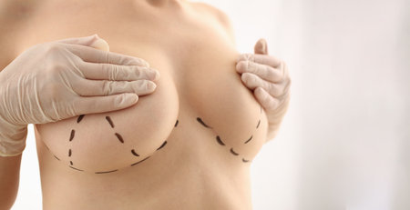 Woman with marks on chest for breast augmentationの写真素材