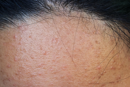 Close-up of acne on the skin, Acne on the face caused by Hormone, The scars, wrinkle and acne inflammation on the face skinの写真素材