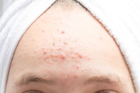 teenage acne on the forehead front view close-upの写真素材