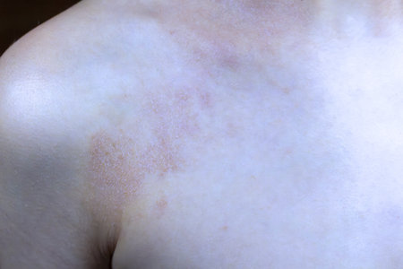 Atopic dermatitis skin rash inflammation on child's torso close upの写真素材