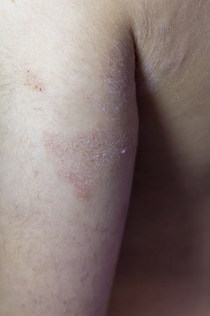 Atopic dermatitis skin rash close up on child's arm showing inflammation and irritation