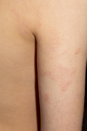 Atopic dermatitis skin inflammation on child's arm close up view