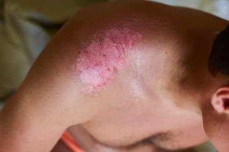 Severe sunburn on the mans shoulder. Ulcers and reddened, itchy skin after sunburnの写真素材