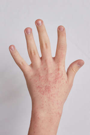 Allergic reactions on the skin of the hands patient. Ill allergic rash dermatitis eczema.の写真素材
