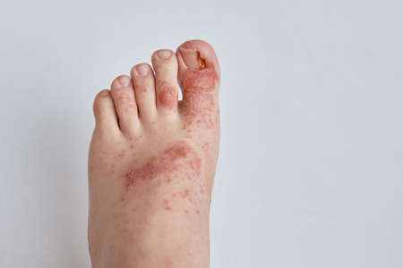 ingrown toenail and allergic rash on the skin of the foot. Dermatological problems, wet eczema and...