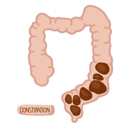Intestine with constipation internal organs digestive system. Abdominal pain. Human large intestine with fecal matter. Vector illustration isolated on white background for medical and educational useのイラスト素材