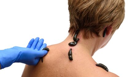 Blood sucking leechs hirudo medicinalis on womans head and shoulders. Hand in blue glove holds a...