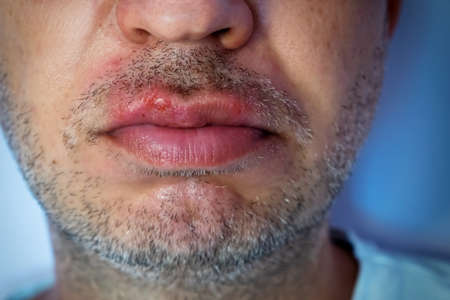 Herpes virus infection in a man on the lips. Medical care photoの写真素材