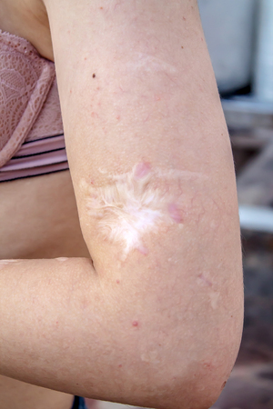 Scars after a burnの写真素材